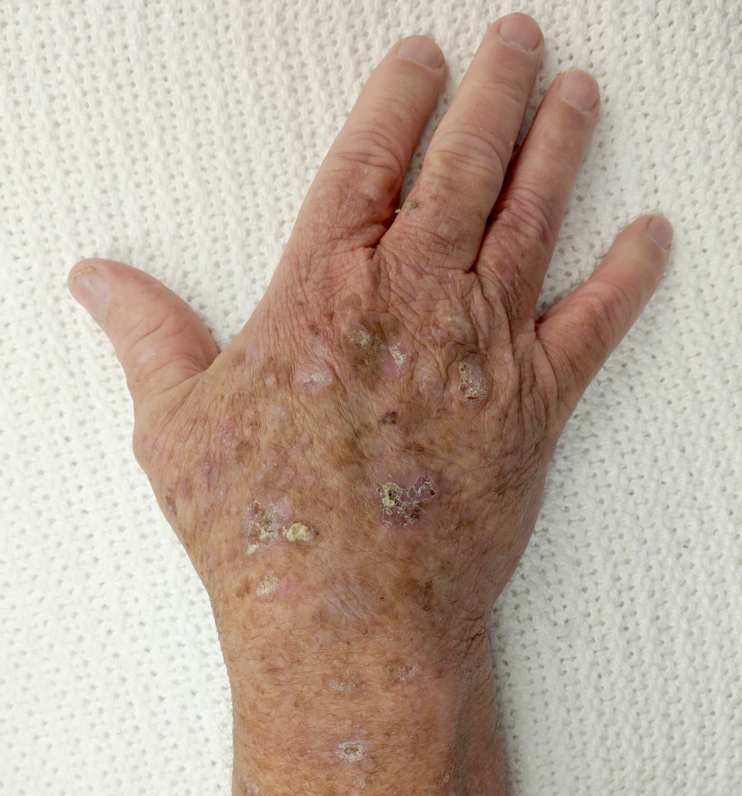 Actinic keratosis sun-damaged skin