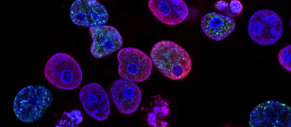 Cellulitis bakteriel hudinfektion behandling