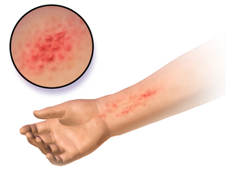 Kontaktdermatitis hudreaktion behandling