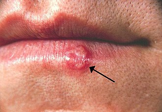 Herpes simplex virus HSV behandling