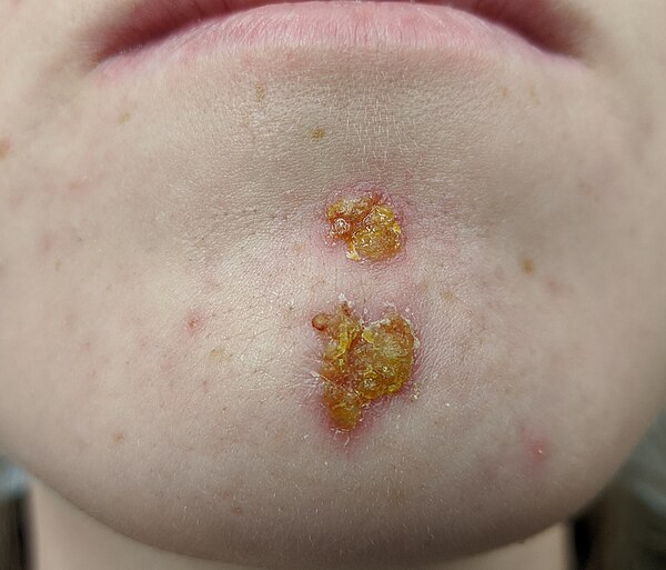 Impetigo bakteriel hudinfektion behandling