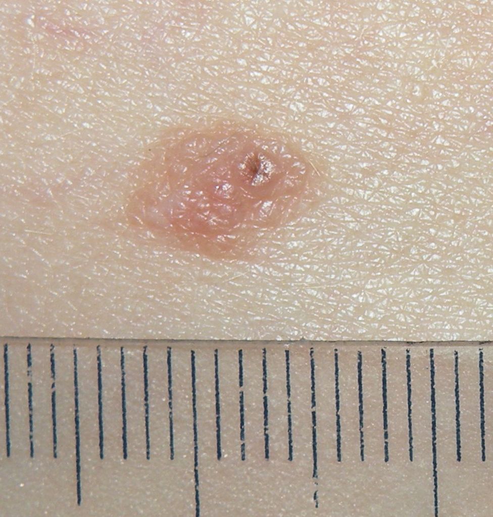 Regular mole on skin